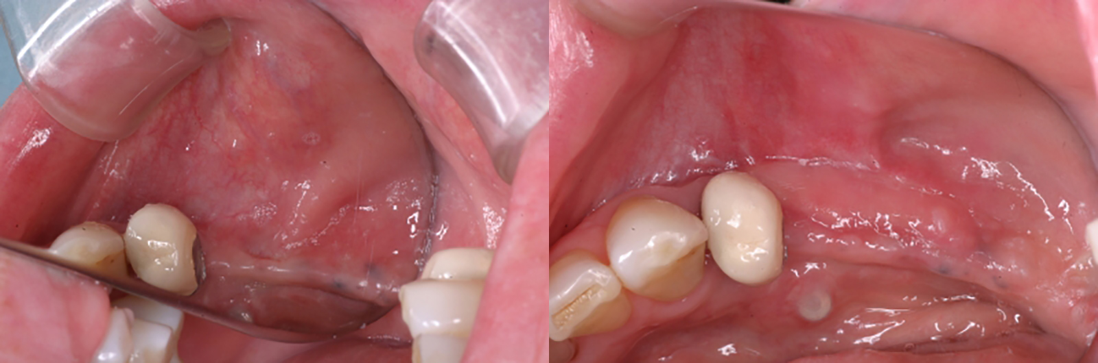表層の歯肉の移植　術前と術後