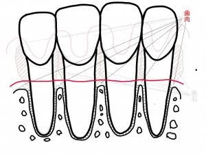 コントロールできた歯周組織