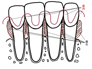 歯周病の歯周組織