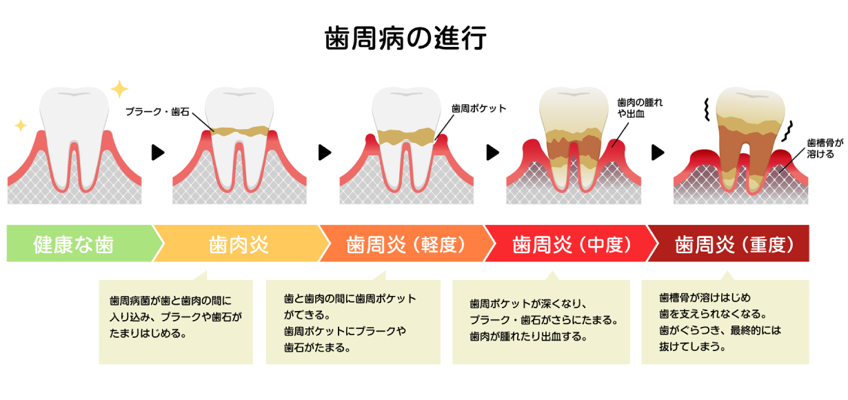 歯周病の進行