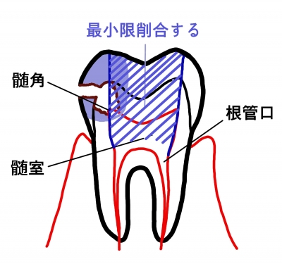 神経をとる治療