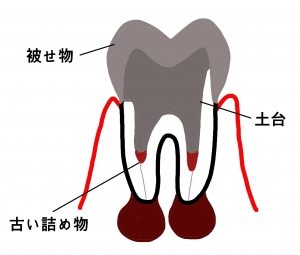 根の治療のやり直し