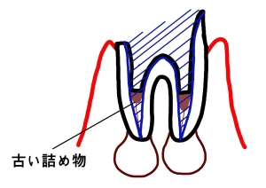 根の治療のやり直し