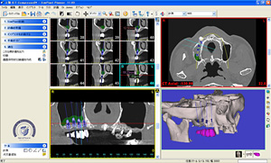インプラント埋入シミュレーション