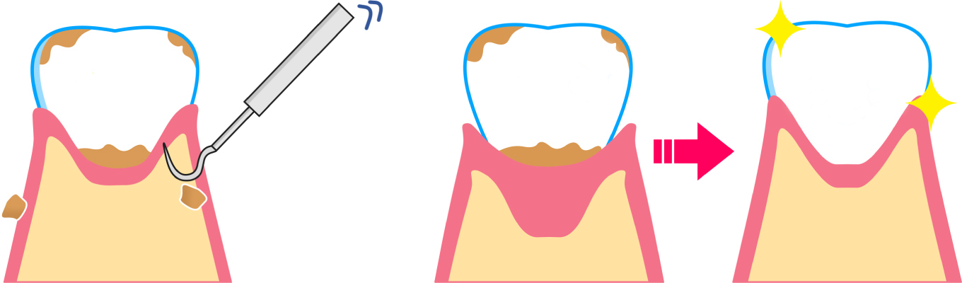 歯石を取るイメージ
